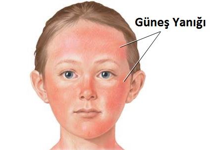 Güneş Yanığı İçin Bitkisel Çözümler